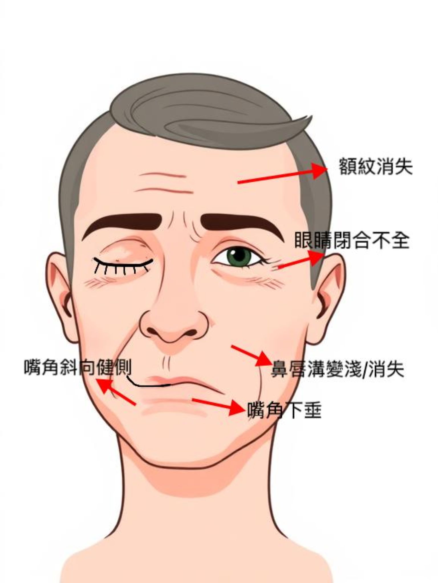 面癱